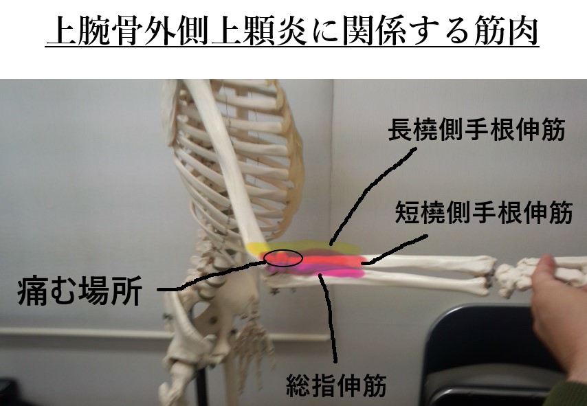 上腕骨外側上顆炎に関係する筋肉