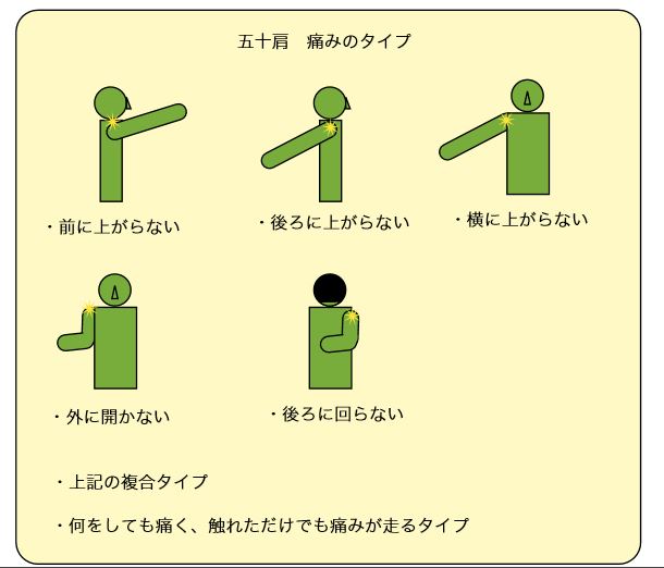 五十肩 痛みのタイプ