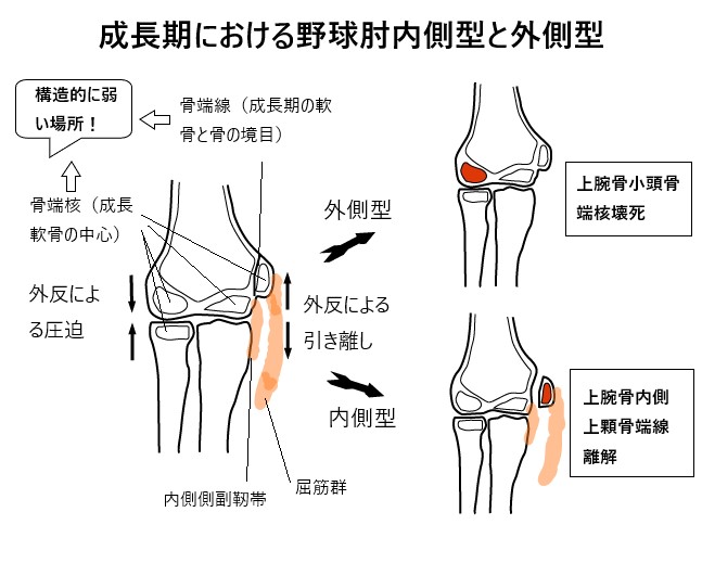 成長期における野球肘内側型と外側型