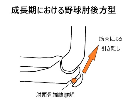 成長期における野球肘後方型