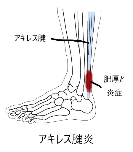 アキレス腱炎の図