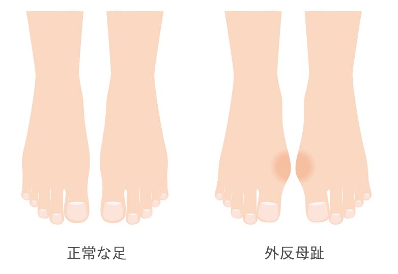 外反母趾説明