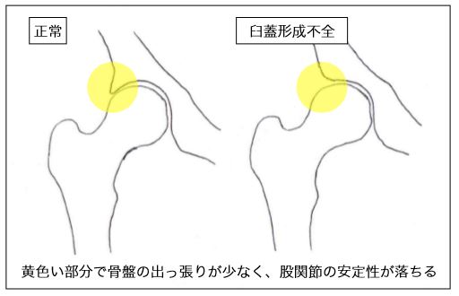 臼蓋形成不全