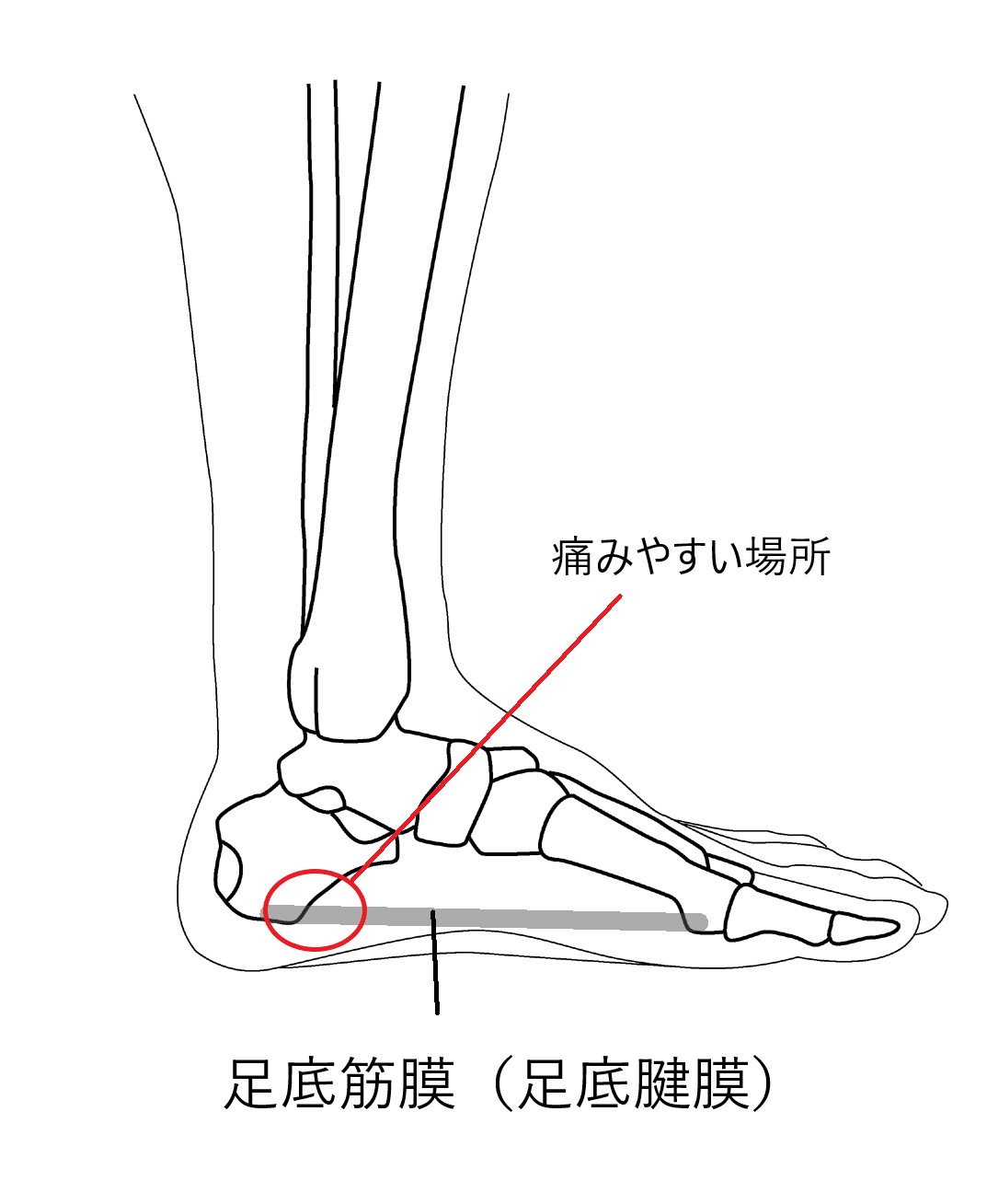 足底筋膜炎