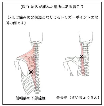 原因が離れた場所にある肩こり