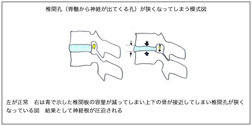 椎間孔が狭くなってしまう模式図
