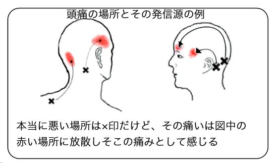 頭痛 場所