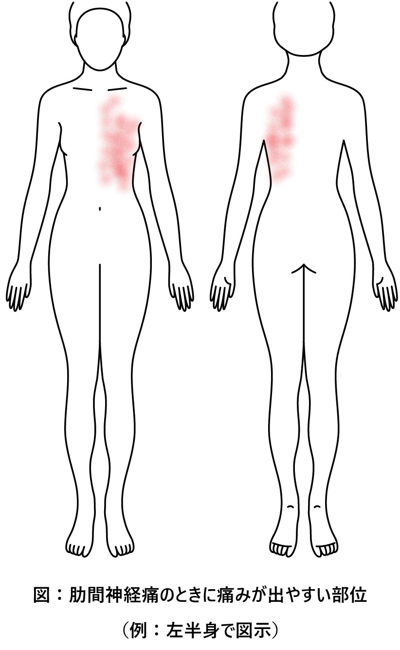肋間神経痛のときに痛みが出やすい部位