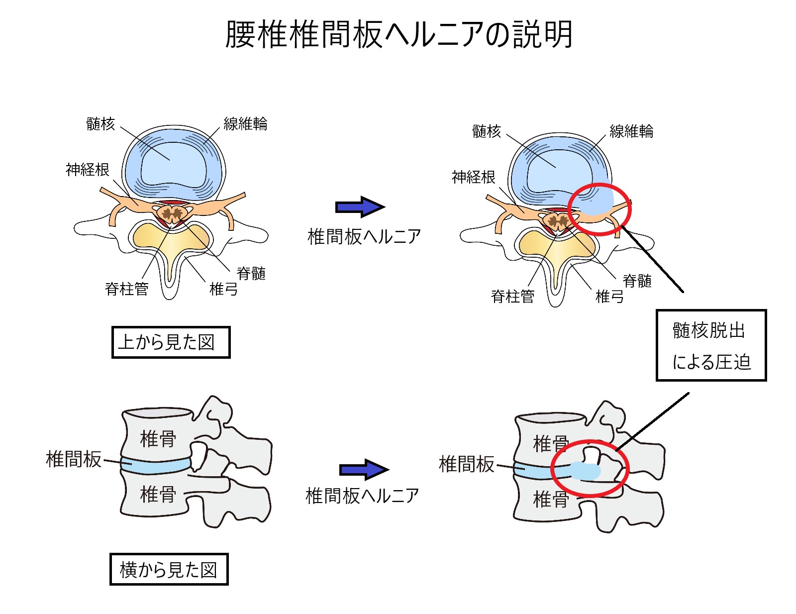 腰椎椎間板ヘルニアの説明