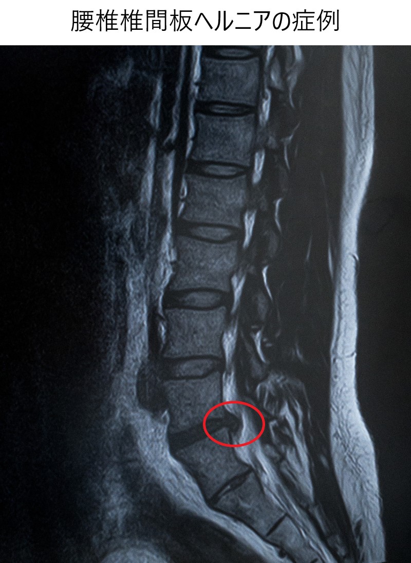 腰椎椎間板ヘルニアの写真