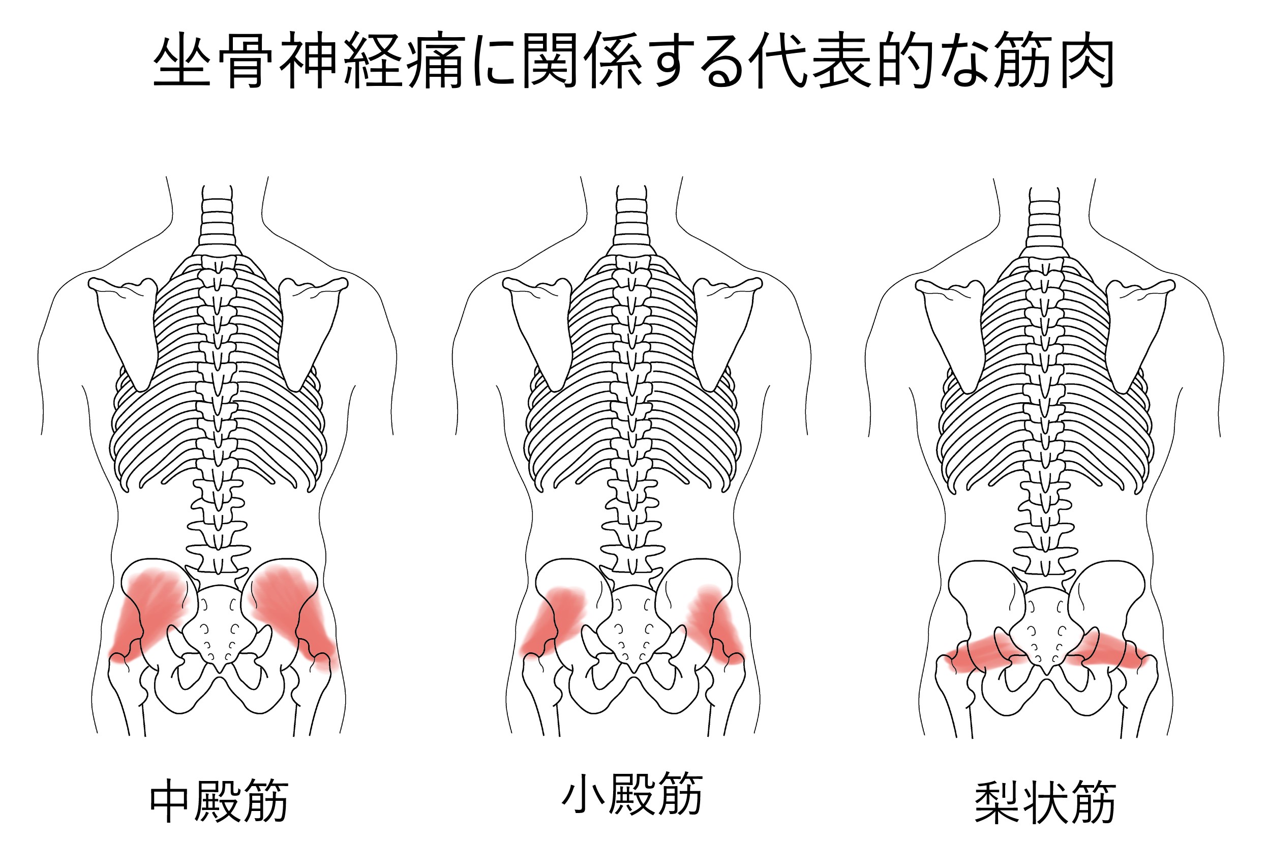 坐骨神経痛に関連する筋肉